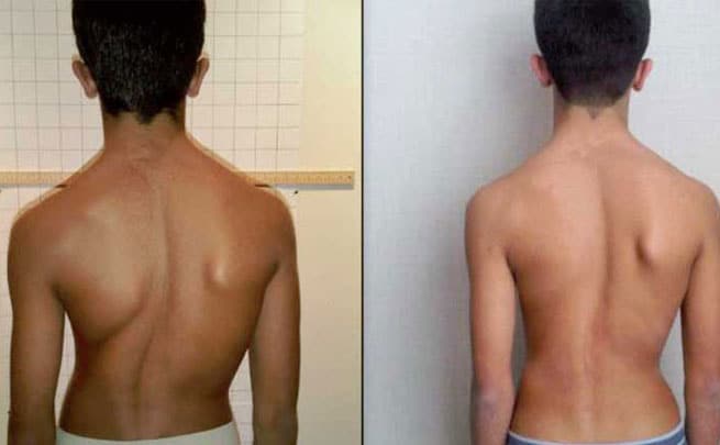 spine-deformity-correction